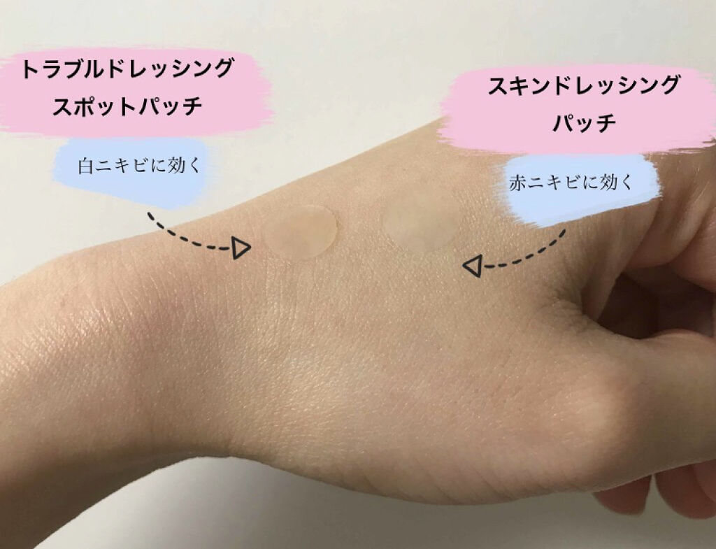 「【韓国発】肌荒れしたときは君に頼りたい。5つの優秀ニキビパッチを比較」の画像(#100342)