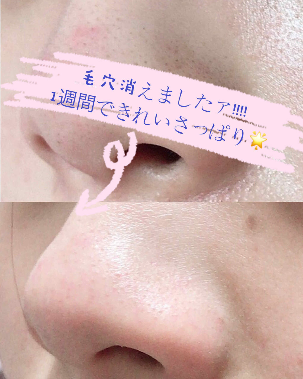 「毛穴や角栓をしっかり除去!ディープクレンジングとは?|おすすめアイテム4選」の画像(#154776)