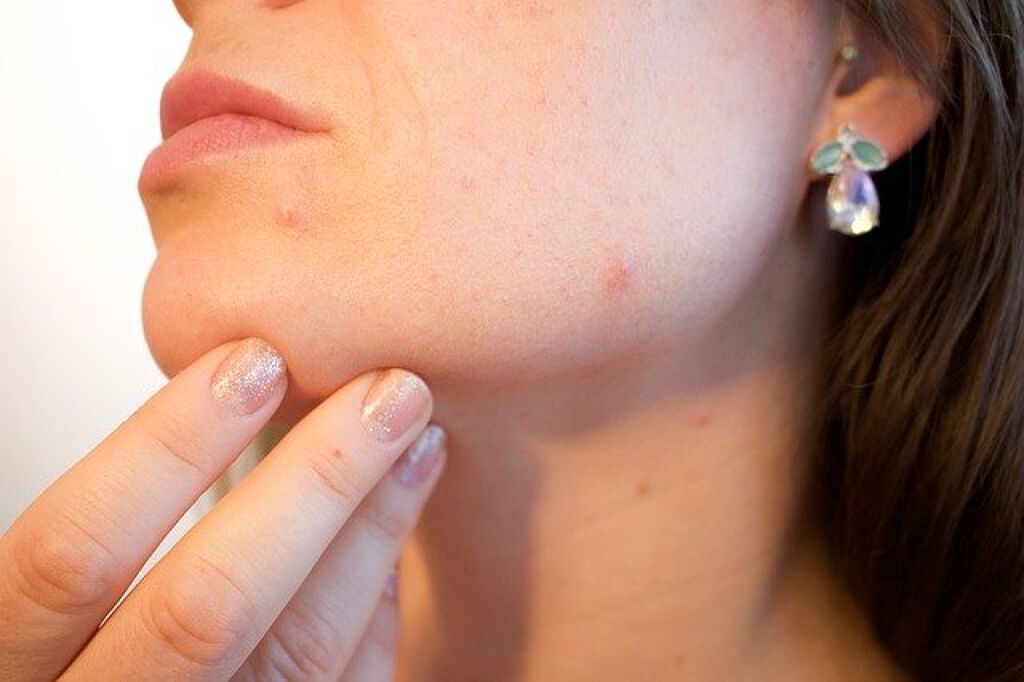 ニキビ跡の赤みを何とかしたい!【セルフケアの方法や口コミ人気のアイテムを一挙紹介】の画像