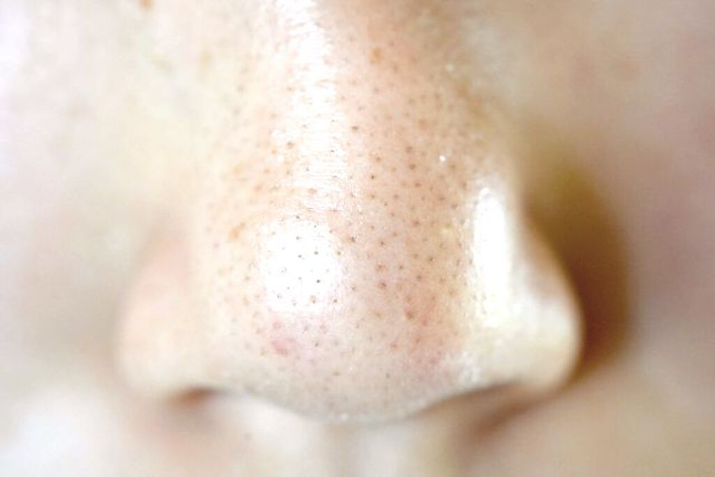 毛穴詰まりの原因と対策が知りたい!今日からできるいちご鼻の角栓ケアの画像