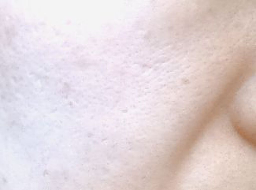 クレーター状のニキビ跡