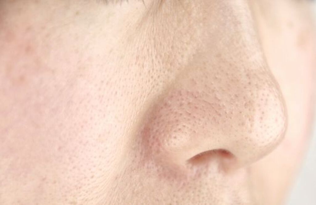 【医師監修】たるみ毛穴の原因は?気になる対策もご紹介《お肌の自信を取り戻す!》の画像