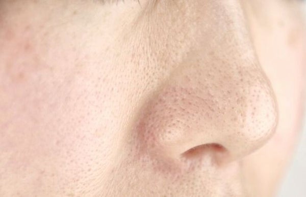 【医師監修】たるみ毛穴の原因は?気になる対策もご紹介《お肌の自信を取り戻す!》の画像