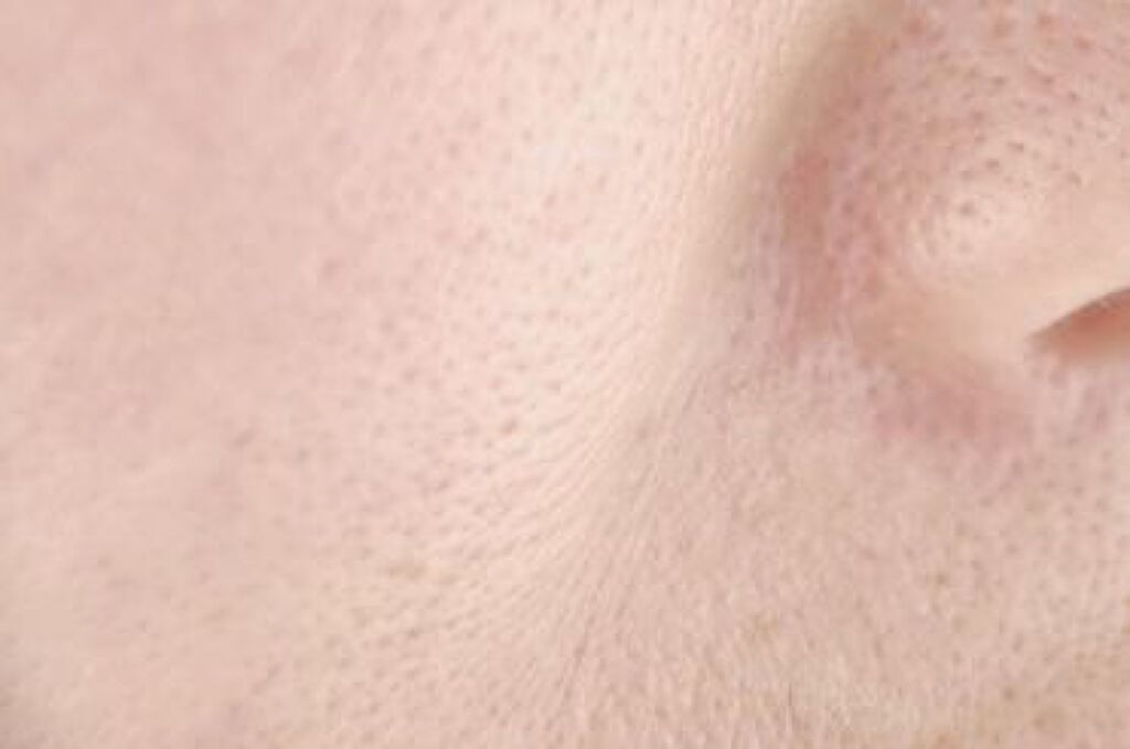 【医師監修】たるみ毛穴の原因は?気になる対策もご紹介《お肌の自信を取り戻す!》の画像