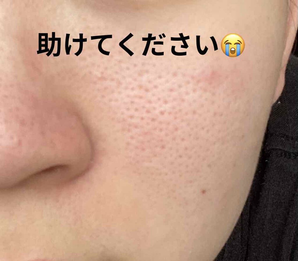 開い た 毛穴 戻ら ない