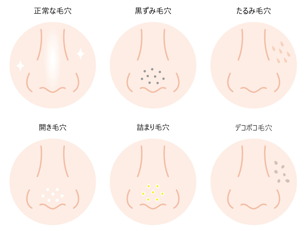 毛穴の開きの治し方は?開き方別の詳しい原因と対策、おすすめの商品を解説!の画像