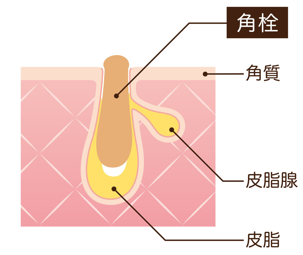 角栓はニキビの始まり？正しいケア方法と予防方法でツルスベたまご肌を手に入れよう♪の画像