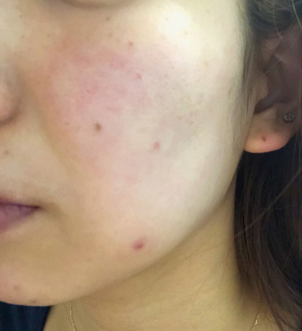 シミ予防におすすめのクリーム7選【プチプラ・デパコス】早めのスキンケアで予防しようの画像