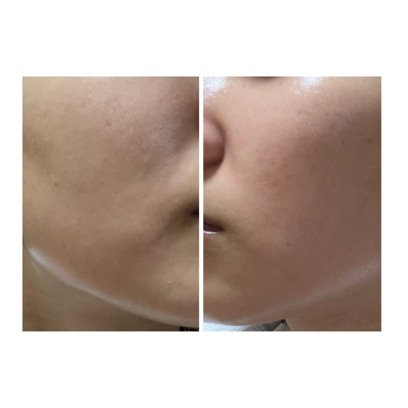 ぽむ on LIPS 「2023.9.13皮膚科に受診 エピデュオとヘパリン処方1枚目..」(4枚目)