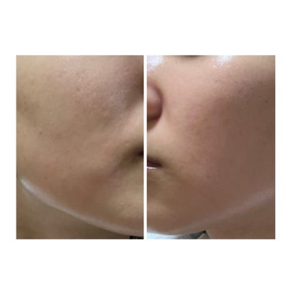 ぽむ on LIPS 「2023.9.13皮膚科に受診 エピデュオとヘパリン処方1枚目..」(4枚目)