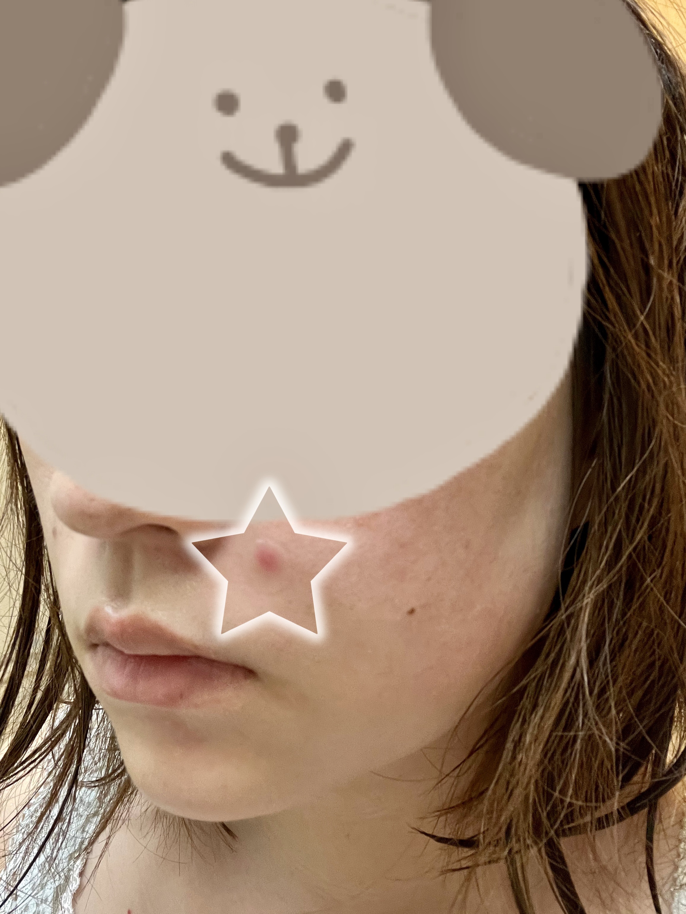 ティーツリーカーミングスポットパッチ/MEDIHEAL/その他スキンケアを使ったクチコミ（3枚目）