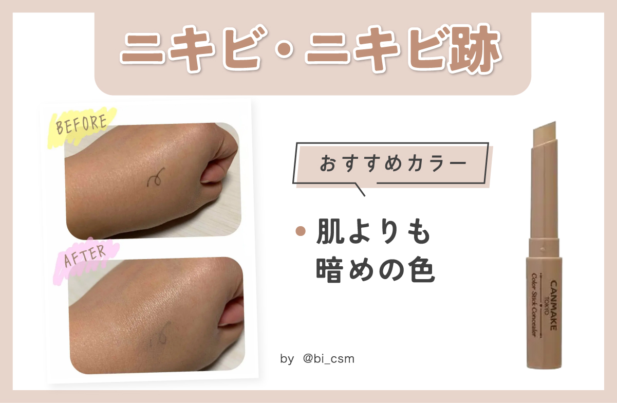 ニキビ・ニキビ跡におすすめカラーは、肌よりも暗めの色。
