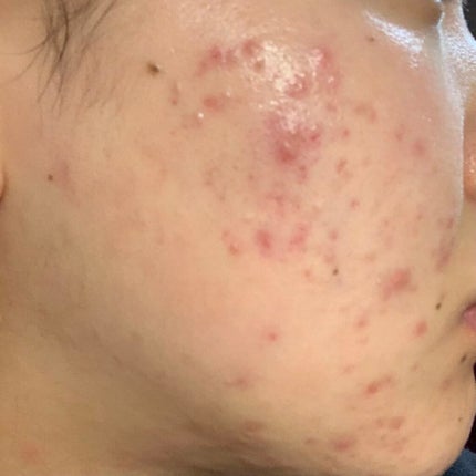 ベピオゲル/マルホ株式会社/その他を使ったクチコミ(2枚目)