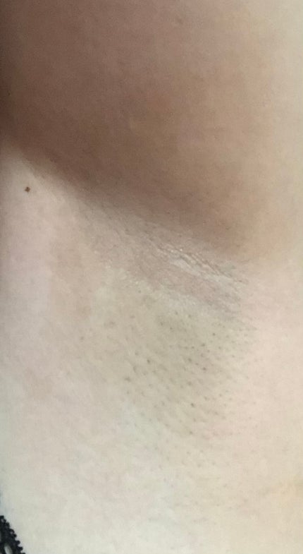 Richesse9 IPL光脱毛器/Richesse9(リシェスナイン)/家庭用脱毛器を使ったクチコミ(2枚目)