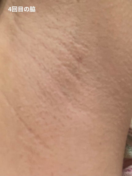 FASIZ HAIR REMOVAL 家庭用脱毛器/FASIZ/家庭用脱毛器を使ったクチコミ(8枚目)
