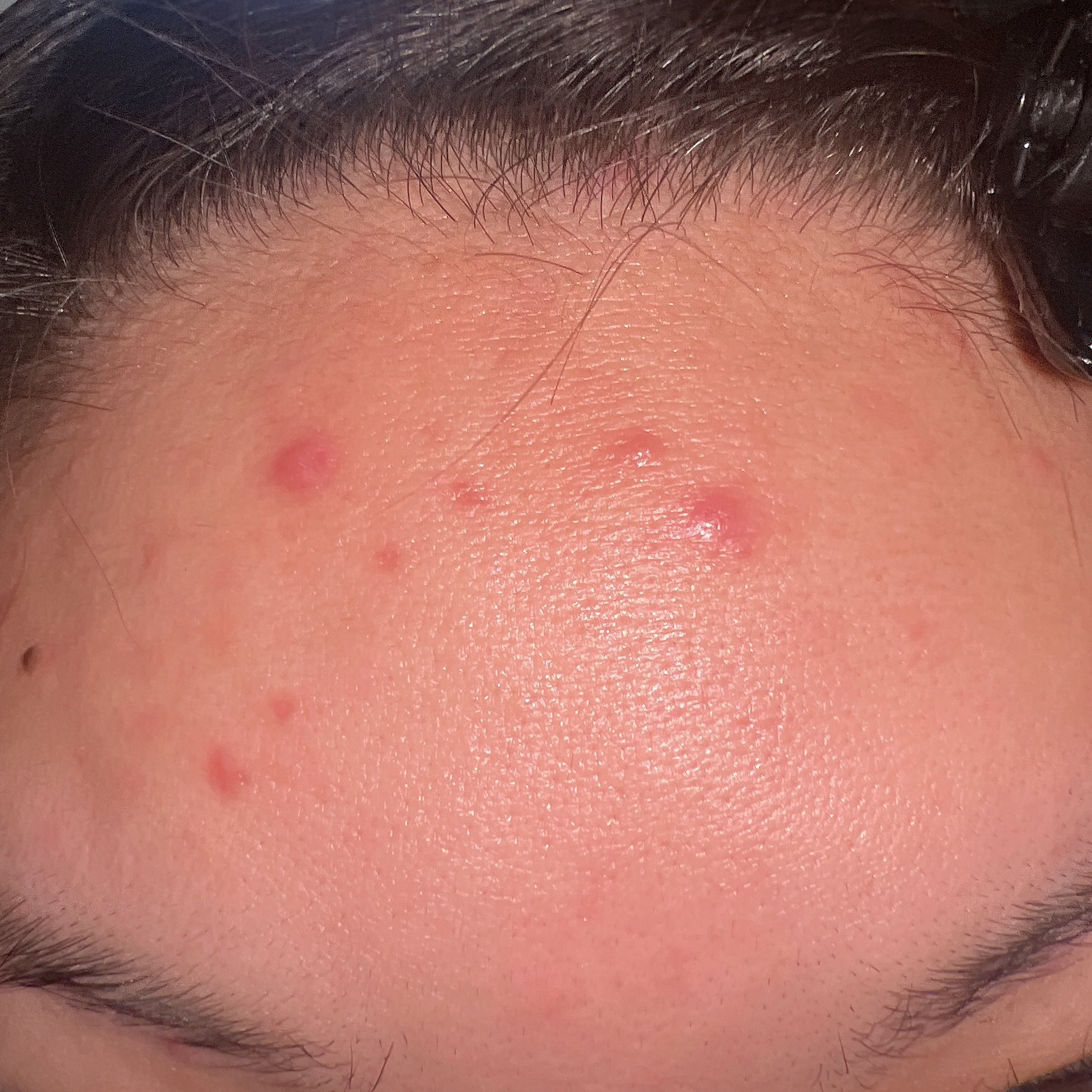 オードムーゲ 薬用ローション（ふきとり化粧水）/オードムーゲ/拭き取り化粧水を使ったクチコミ（2枚目）