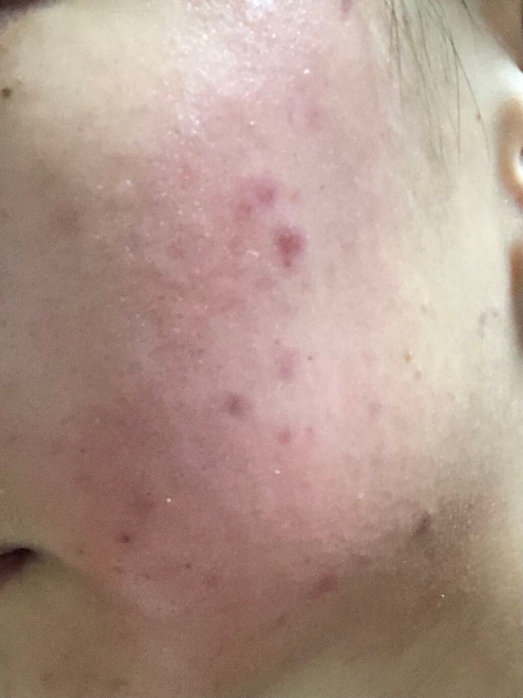 ちー on LIPS 「汚くてすいません。デュアック配合ゲルを2週間使用して、2.3日..」(2枚目)