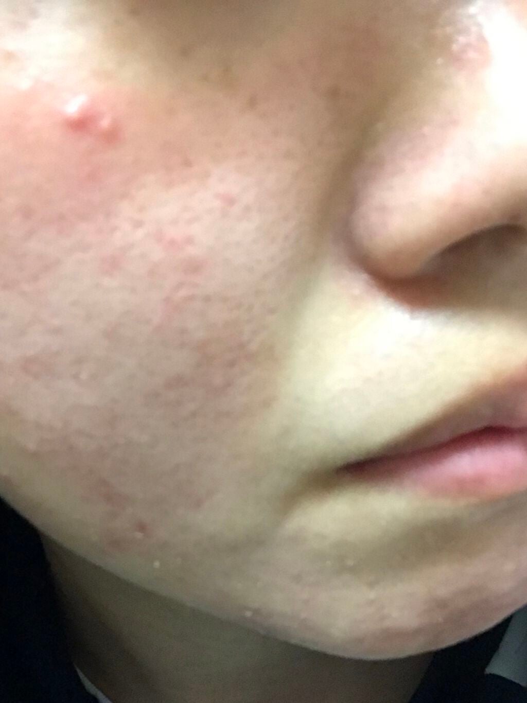 nnn____04 on LIPS 「ニキビ治療Day30&31..」(1枚目)