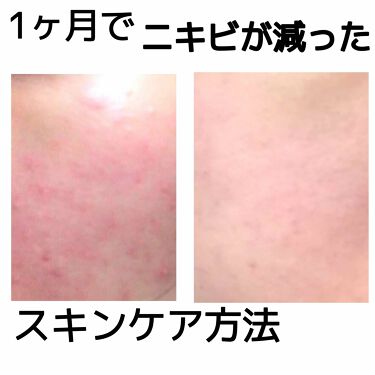クラブ すっぴんパウダー クラブを使った口コミ 季節のせいなのか分かりませんが肌が真っ赤に By まかろなっち 敏感肌 代前半 Lips クラブ すっぴんパウダー クラブを使った口コミ 季節のせいなのか分かりませんが肌が真っ赤に By まかろなっち 敏感肌 代前半 Lips