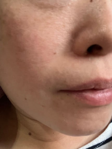 シカレチA エッセンス0.1/VT/美容液を使ったクチコミ(7枚目)