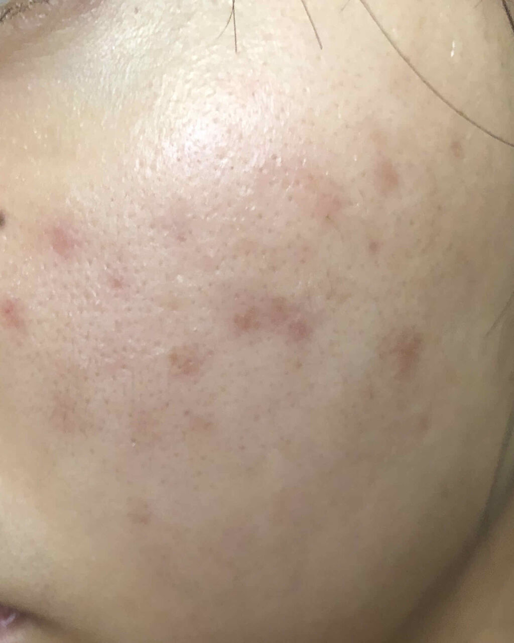 クリンダマイシンゲル(医薬品)/クラシエ薬品/その他を使ったクチコミ（2枚目）