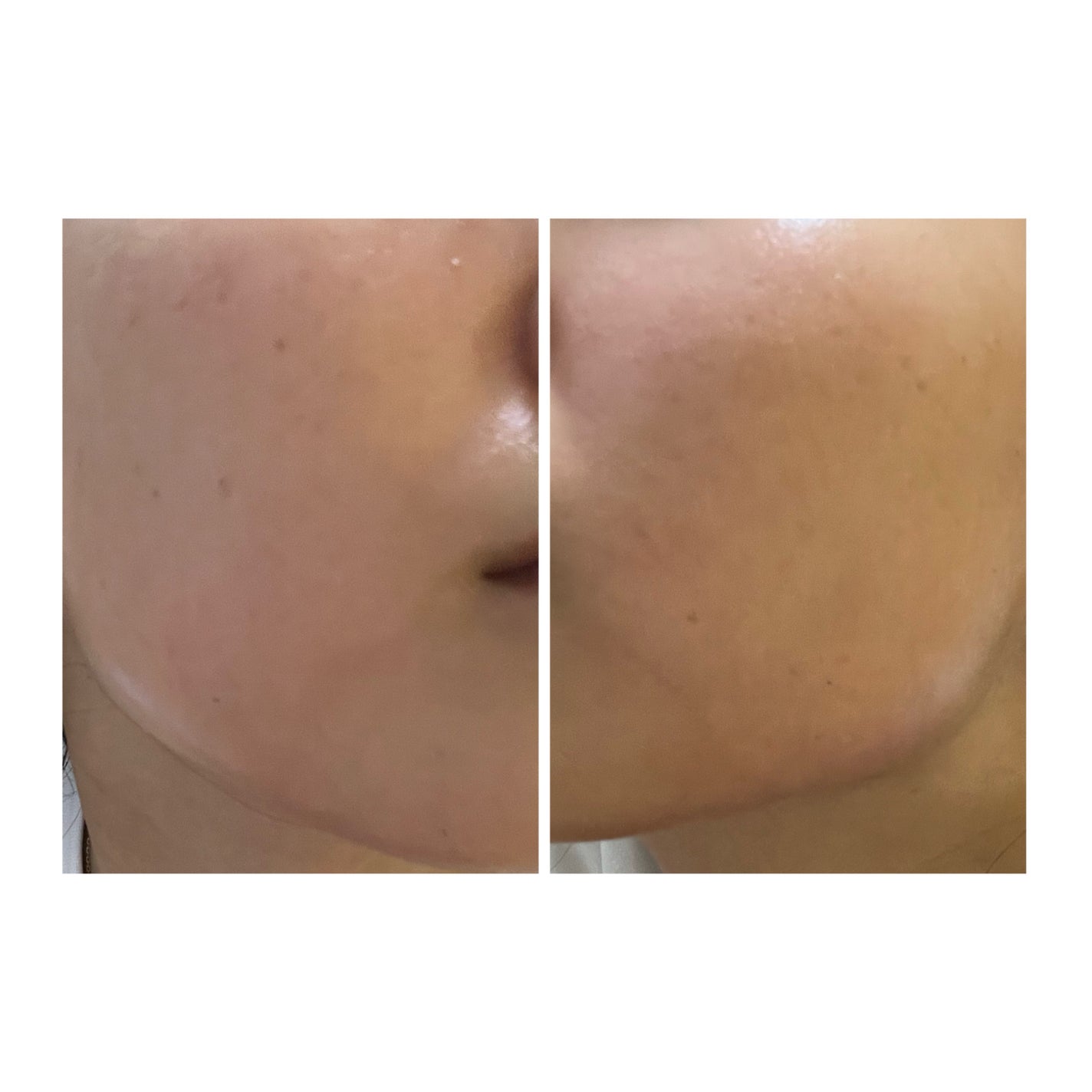 ぽむ on LIPS 「2023.9.13皮膚科に受診 エピデュオとヘパリン処方1枚目..」(2枚目)