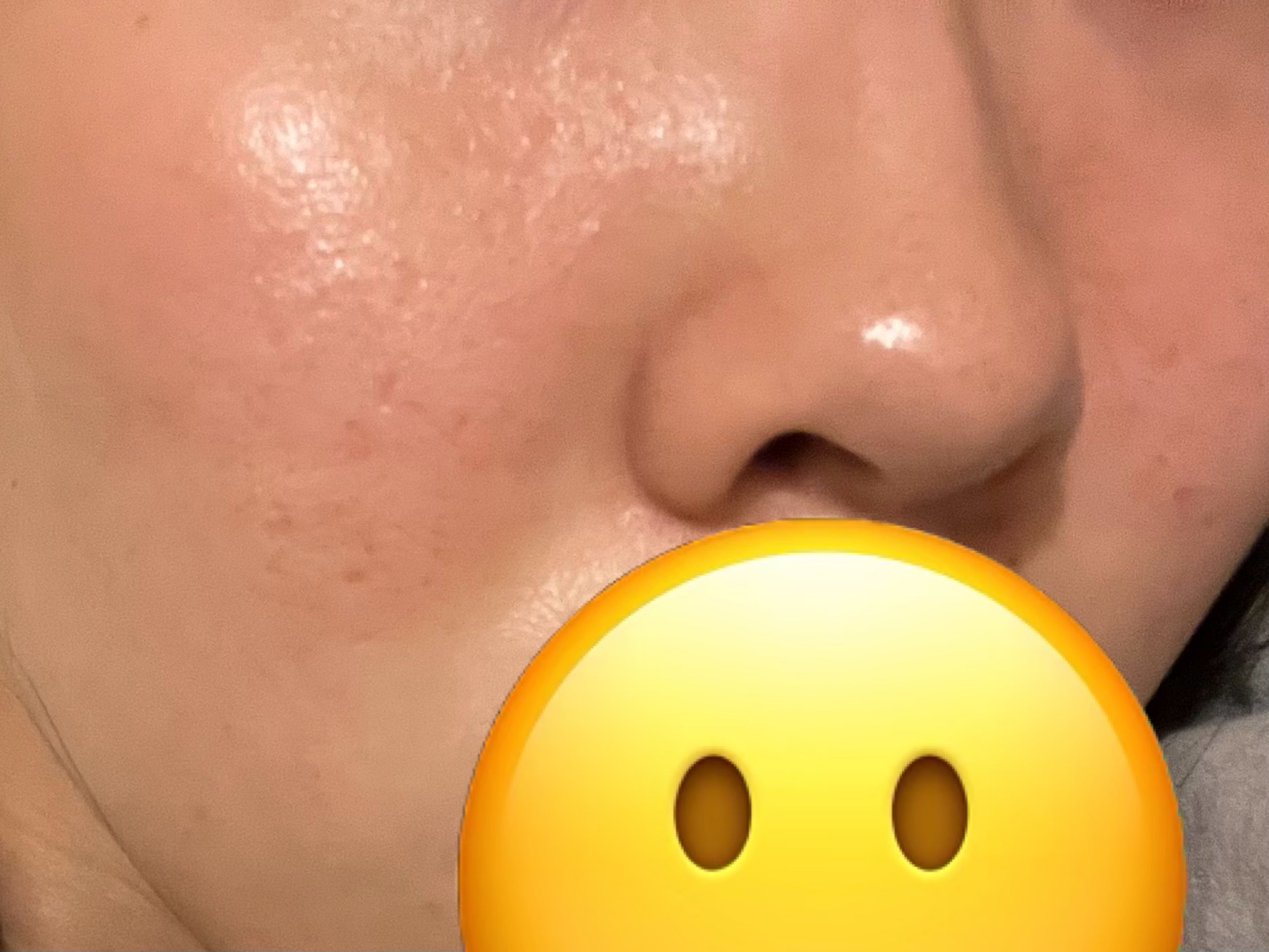 アクネケア 化粧液　＜医薬部外品＞/ファンケル/化粧水を使ったクチコミ（3枚目）