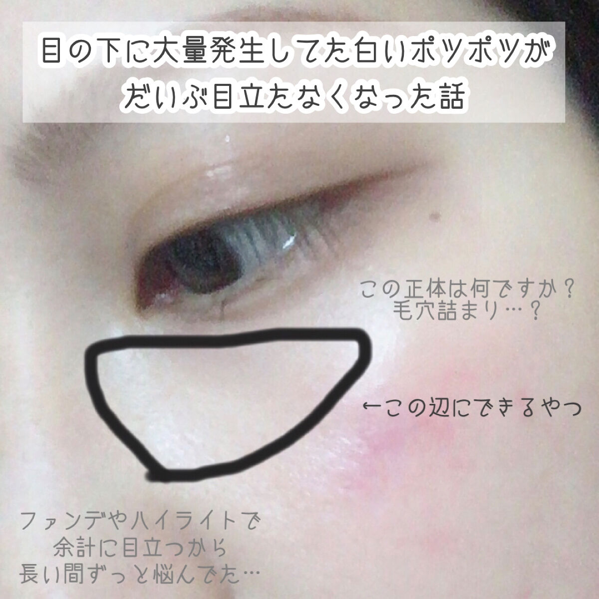 薬用 しみ 集中対策 美容液/メラノCC/美容液を使ったクチコミ（1枚目）