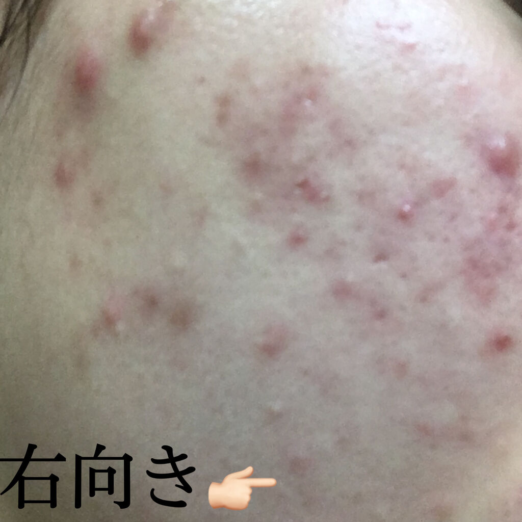 ハトムギ化粧水(ナチュリエ スキンコンディショナー R )/ナチュリエ/化粧水を使ったクチコミ（3枚目）