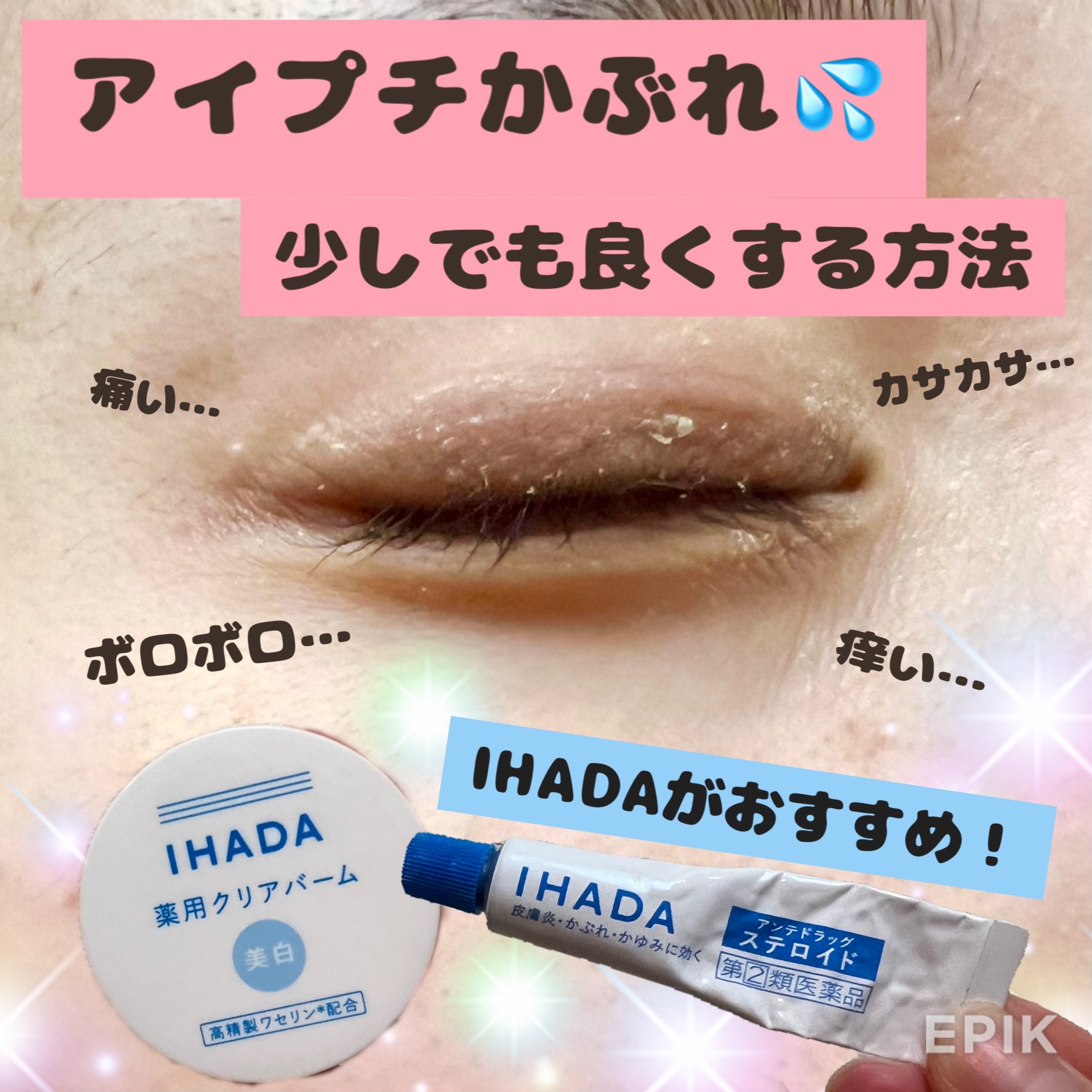 キュアロイド軟膏（医薬品）/IHADA/その他を使ったクチコミ（1枚目）