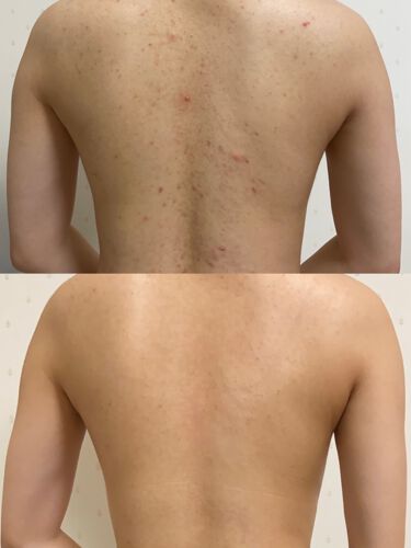 22年最新 ニキビ 治す 高校生特集 口コミで人気の44アイテムを紹介 Lips