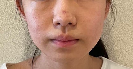 ティーツリーケアソリューション アンプルマスクJEX/MEDIHEAL/シートマスク・パックを使ったクチコミ(2枚目)