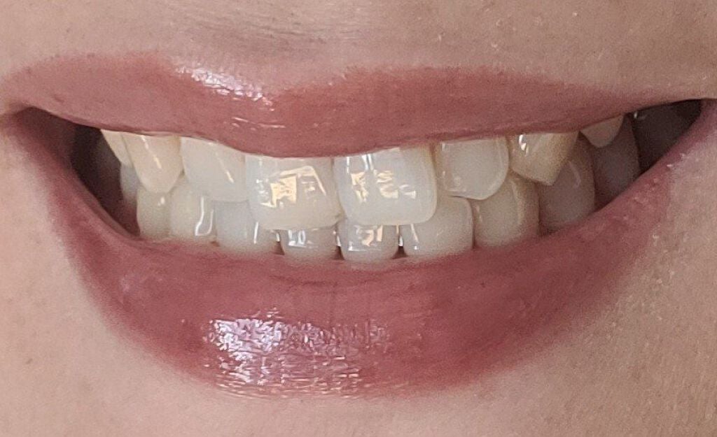 ホワイティエッセンス/MiiS/その他オーラルケアを使ったクチコミ(3枚目)