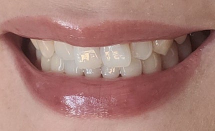 ホワイティエッセンス/MiiS/その他オーラルケアを使ったクチコミ(3枚目)