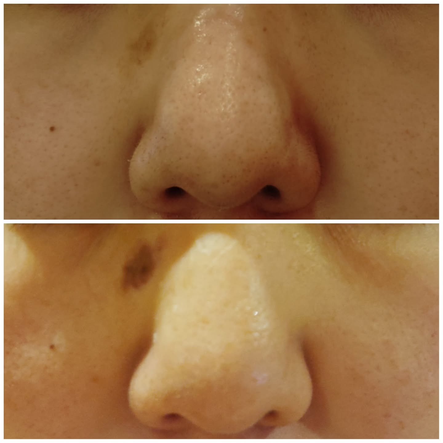 トラネキサム酸　250mg/東和薬品/その他を使ったクチコミ（3枚目）