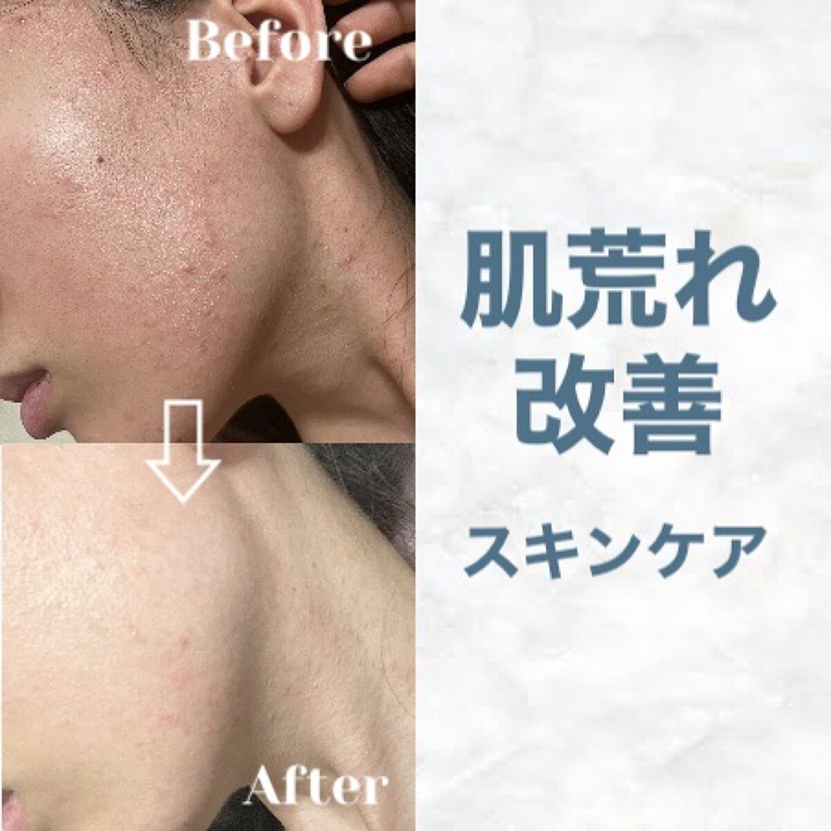 マジックティーツリーオイル/ブラン/フェイスオイルを使ったクチコミ（1枚目）