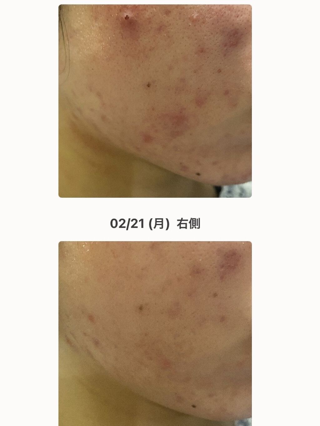 美容原液 オパール R-III/薬用 オパールR-Ⅲ/美容液を使ったクチコミ（2枚目）