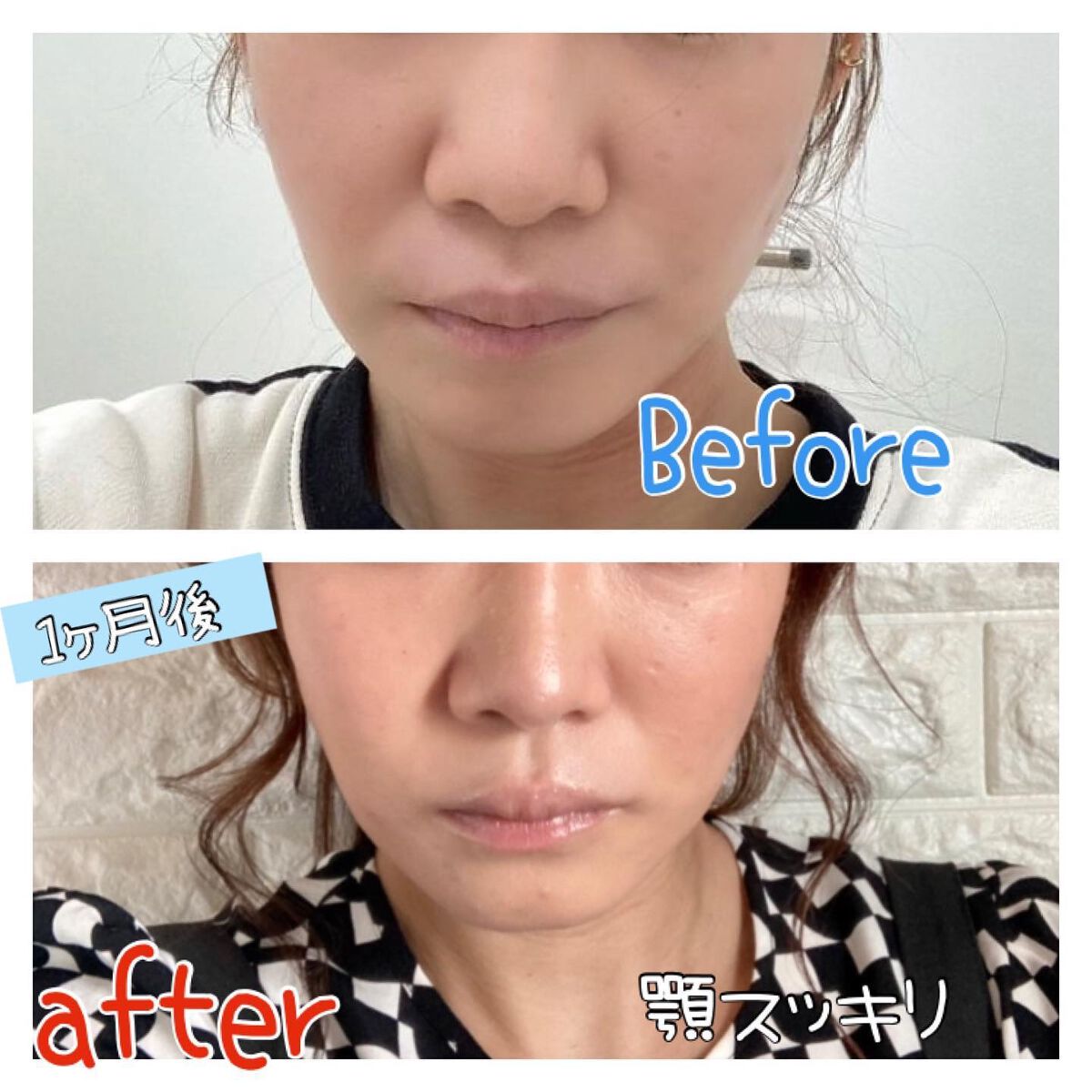 ちゃんぶぅ 投稿ある方フォロバ💕あんまり開かないから遅いよ on LIPS 「はじめての医療ハイフ受けてきた。レポ『M.CLINICウルトラ..」(2枚目)