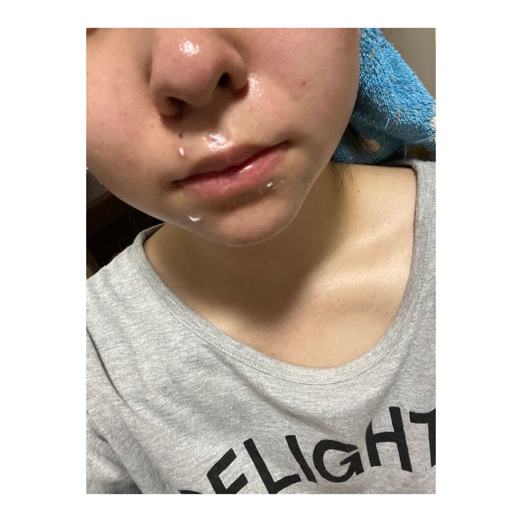 ペアアクネクリームW(医薬品)/ペア/その他を使ったクチコミ（3枚目）