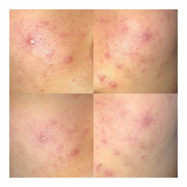 メイクアップベースs グリーン Mediaの口コミ ニキビ痕による頬の赤みに悩んでたときに出会 By 柚月 乾燥肌 代前半 Lips