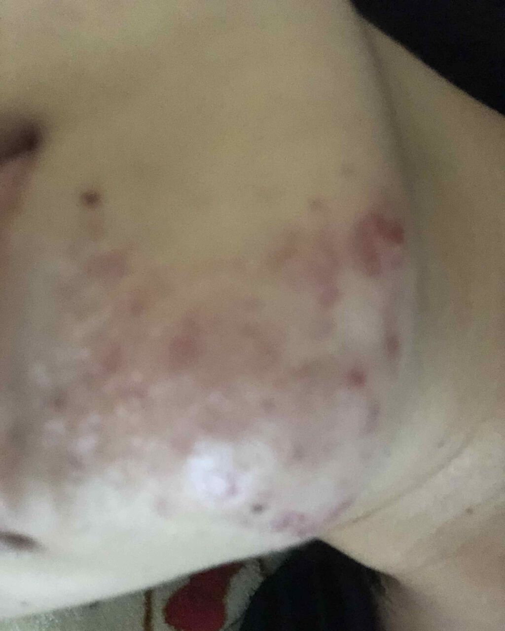 桂枝茯苓丸加ヨクイニン(医薬品)/ツムラ/その他を使ったクチコミ（3枚目）