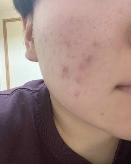 薬用クリーム洗顔/メンソレータム アクネス/洗顔フォームを使ったクチコミ(3枚目)