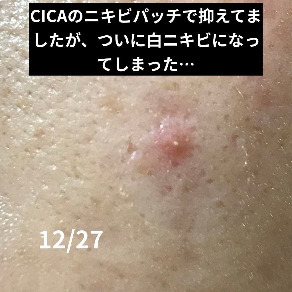 プロCICA クリアスポットパッチ/VT/その他スキンケアを使ったクチコミ(6枚目)
