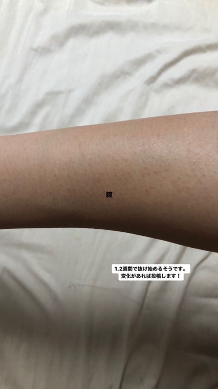 剛毛女 on LIPS 「医療脱毛1回目。閲覧注意。TikTokにも載せているので良かっ..」(9枚目)