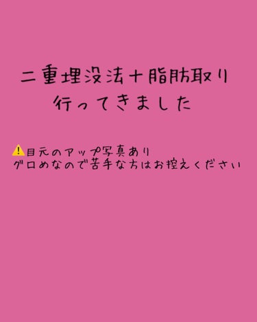 今までは見る専でしたが、今日思い切って二重整形したので、記録がてら、二重整形を検討している方の参考になればと思い投稿しました。

不慣れですが、よろしくお願いします🙇‍♀️

もともと重く厚い一重のため