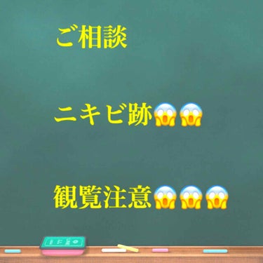 ⇐本当に観覧注意です。ご注意ください😱
不快な思いをさせてしまいすみません。

中二女子です。この通りニキビがひどいです…ニキビもそうですがニキビ跡？ですかね？
本当に鏡を見てテンション下がります😔

