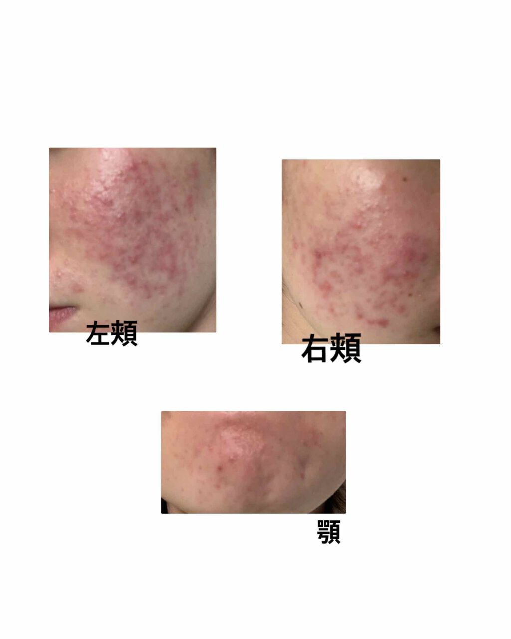 io on LIPS 「助けてください😥😥中学1年から約6年間ニキビ→ニキビ跡と肌が荒..」(2枚目)