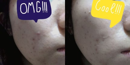 ゼロスポットパッチ/Today’s Cosme/にきびパッチを使ったクチコミ(4枚目)