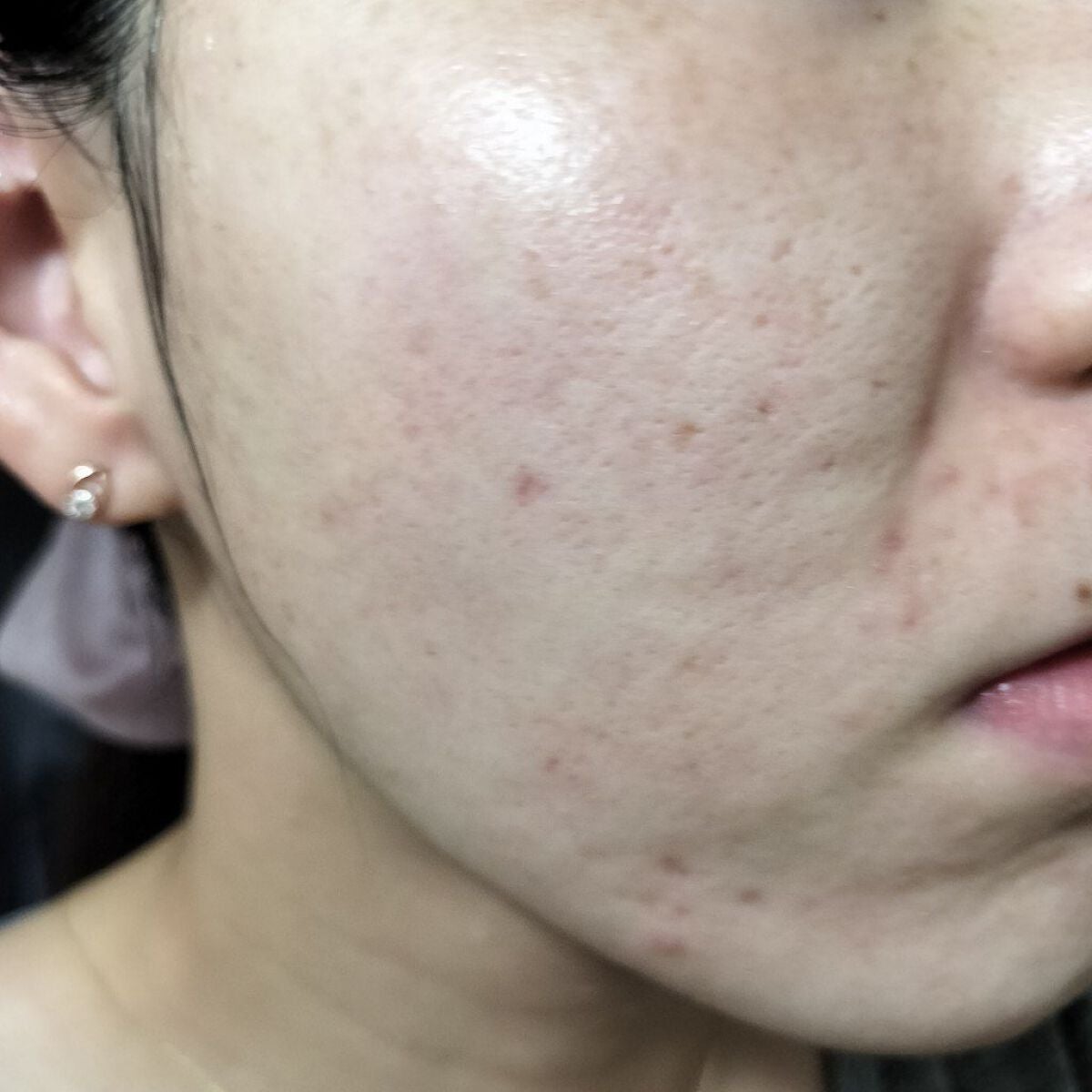 miina@汚肌工事録⚠️ on LIPS 「9/19の#汚肌工事録まだまだ忙しいのですが復活できました☺️..」(1枚目)