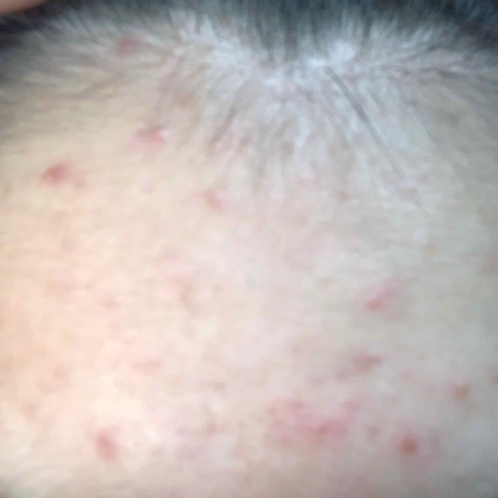 オロナインＨ軟膏 (医薬品)/オロナイン/その他を使ったクチコミ（2枚目）